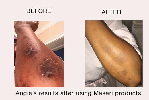 Are Makari products only for whitening the skin?